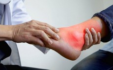 Bệnh gout không chỉ do ăn uống