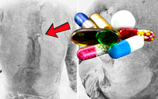 Dùng thuốc trị gout, người bệnh hoại tử da, nguy kịch tính mạng