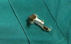 Bé 13 tuổi ho kéo dài hơn 3 năm, bác sĩ phát hiện dị vật nhựa trong phế quản