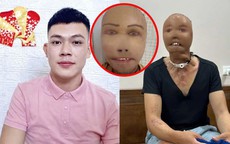 Ngã úp mặt vào nước sôi, chàng trai 31 tuổi mất thị lực, gương mặt biến dạng