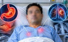 Tưởng đau dạ dày, người đàn ông bất ngờ mắc ung thư phổi giai đoạn cuối