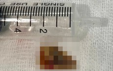 Mảnh xương 2 cm nằm sâu trong phế quản, gây tắc phổi và nhiều ổ mủ
