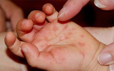 Cách vệ sinh răng miệng và chăm sóc da cho trẻ mắc tay chân miệng tại nhà