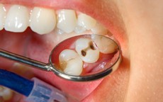 4 thói quen thường gặp có thể khiến răng sâu nhanh hơn