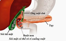 Sỏi túi mật khi nào cần mổ cấp cứu?