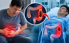 Đau bụng âm ỉ, người đàn ông nhập viện khi đại tràng đã tắc hoàn toàn