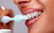 Vệ sinh răng miệng khi niềng răng như thế nào?