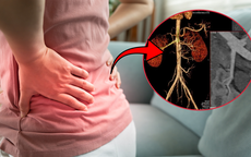 Đi khám vì đau hông lưng, phát hiện túi phình động mạch thận kích thước lớn