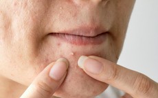 5 cách giảm nguy cơ để lại vết thâm sau mụn trứng cá