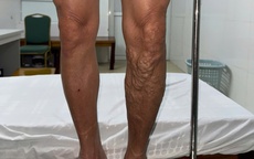 Đừng để 'đôi chân mệt mỏi' cướp mất niềm vui đón Xuân