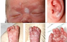 Bác sĩ chỉ cách phát hiện sớm và điều trị giang mai bẩm sinh