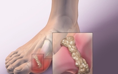 Người bệnh gout khổ sở với tiệc tùng cuối năm