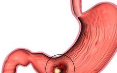 Viêm loét dạ dày dễ tái phát vào dịp cuối năm