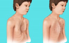 Thanh niên 18 tuổi mắc hội chứng Marfan biến chứng tim mạch nguy hiểm, bác sĩ cảnh báo dấu hiệu nhận biết sớm