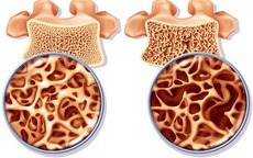4 bí quyết giúp người lớn tuổi giảm nguy cơ loãng xương