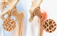 8 cách tăng mật độ xương, giảm nguy cơ loãng xương và gãy xương