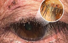 Phát hiện ổ rận mu bám dày trên mí mắt người phụ nữ