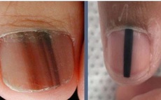 Sọc sẫm màu trên móng tay, móng chân là biểu hiện của bệnh gì?
