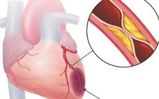 Dùng thuốc đúng cách giúp kiểm soát mỡ máu cao, phòng ngừa biến chứng tim mạch