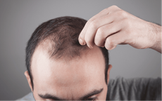 5 loại dầu dưỡng tự nhiên tốt nhất cho nam giới bị hói đầu