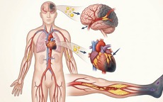 Những biến chứng nguy hiểm khi không kiểm soát mỡ máu