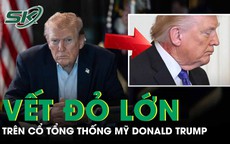 Tổng thống Mỹ Donald Trump xuất hiện với vết đỏ lớn trên cổ gây đồn đoán về sức khỏe