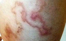 Bệnh ký sinh trùng nhiều người dương tính khi xét nghiệm ở Khánh Hòa nguy hiểm mức nào nếu không điều trị sớm?