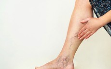 Yếu tố nguy cơ không nên xem nhẹ của suy tĩnh mạch chi dưới