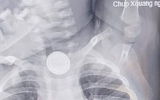 Nuốt pin cúc áo, bé 2 tuổi bỏng nặng thực quản