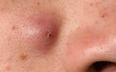 Mụn bọc trên mặt dễ biến chứng nếu tự ý nặn mụn