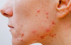7 yếu tố dẫn đến tình trạng mụn viêm trên da