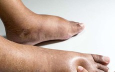 Chân voi là bệnh gì, có nguy hiểm không?