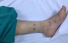 Bé 11 tuổi tử vong do não mô cầu thể tối cấp tại TPHCM