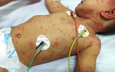 Bé gái 11 tuổi tử vong do viêm não mô cầu: Dấu hiệu nhận biết và cách phòng căn bệnh có nguy cơ tử vong trong 24 giờ