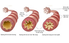Bệnh hen có lây không?
