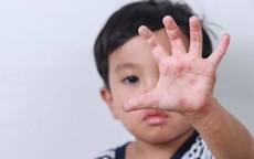 Vì sao bệnh tay chân miệng tăng mạnh ở trẻ mầm non vào đầu tuần?