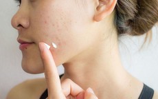 6 sai lầm khi chữa mụn trứng cá