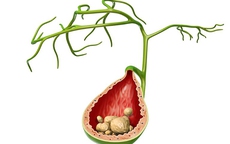 Vì sao sỏi mật hay tái phát và cách phòng ngừa hiệu quả