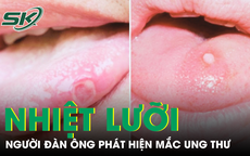 Người đàn ông phát hiện mắc ung thư từ dấu hiệu lạ ở lưỡi