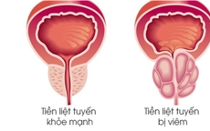 Viêm tuyến tiền liệt có dễ phát hiện không?