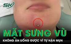 Nặn mụn cằm, người phụ nữ nhập viện vì mặt sưng vù, không ăn uống được 