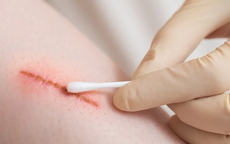 Đừng chủ quan với các vết trầy xước nhỏ