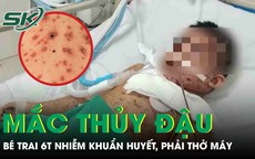 Biến chứng thủy đậu, bé trai 6 tuổi nhiễm khuẩn huyết, phải thở máy nguy kịch