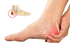 Biểu hiện điển hình khi mắc gai gót chân, đừng chủ quan với những cơn đau ở bàn chân