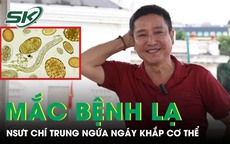 NSƯT Chí Trung mắc bệnh lạ, cơ thể đỏ như 'tôm luộc'