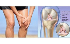 Đau khớp gối khi leo cầu thang có đáng lo?