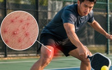 Chơi Pickleball, bóng đá mùa nóng: Nam giới dễ bị nhiễm trùng da