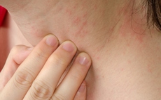 Mẩn ngứa ở trẻ cần xử trí như thế nào?
