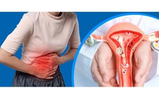 7 dấu hiệu thường gặp của lạc nội mạc tử cung chị em nên chú ý