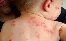 Bệnh chốc mùa hè: Nhận biết sớm để tránh biến chứng